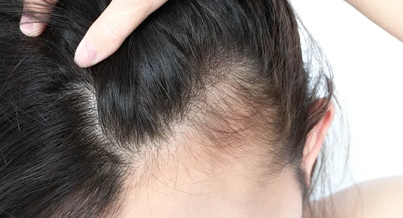 Thinning hair